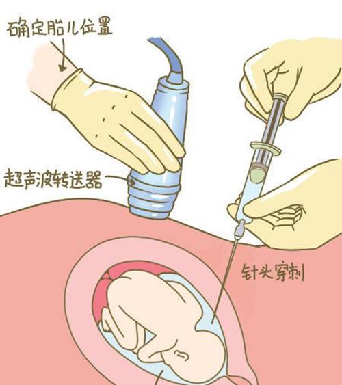 慈溪市羊水孕期亲子鉴定